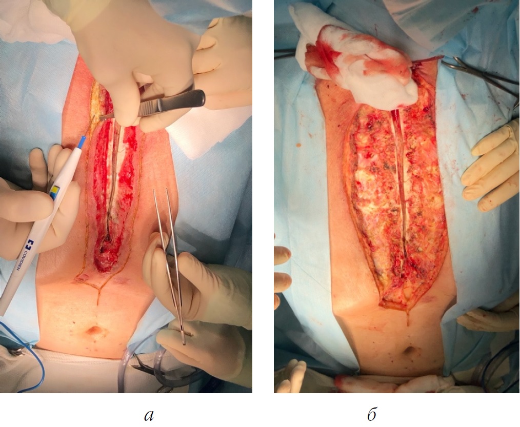 Two-staged tactics of treatment of postoperative sternomediastinitis using  technique of negative pressure followed by two-flap omentoplasty according  to K. Yoshida - Kasatov - Perm Medical Journal