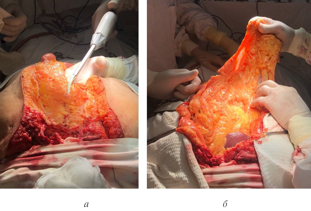 Two-staged tactics of treatment of postoperative sternomediastinitis using  technique of negative pressure followed by two-flap omentoplasty according  to K. Yoshida - Kasatov - Perm Medical Journal